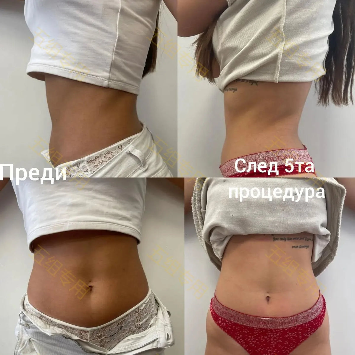 EMS Body Sculpting Machine MYOslim Muscle Building Fat Burning Abdominal Sculpting 15T 6500W Weight Lose Machine